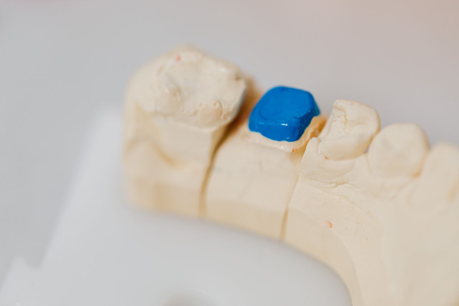 A plaster model of a lower jaw with a blue filling in one molar